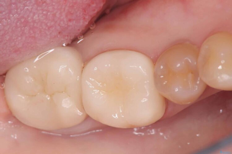 長期的な安定性を重視したセラミック治療 アフター