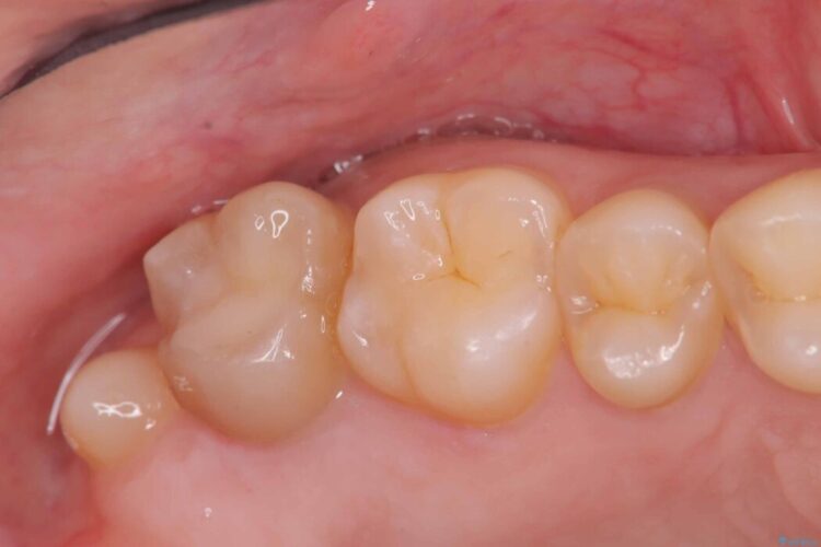 詰め物の下の見えない虫歯 アフター