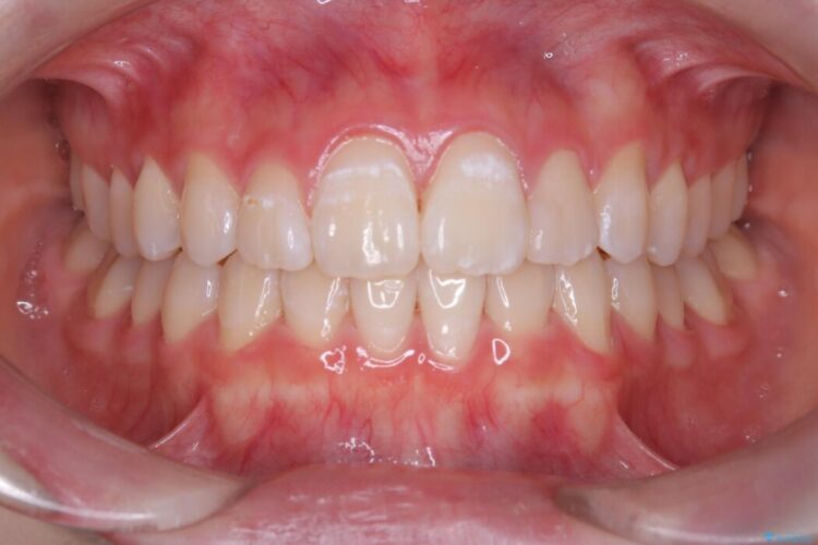 インビザラインで前歯のガタつきを改善 治療後画像