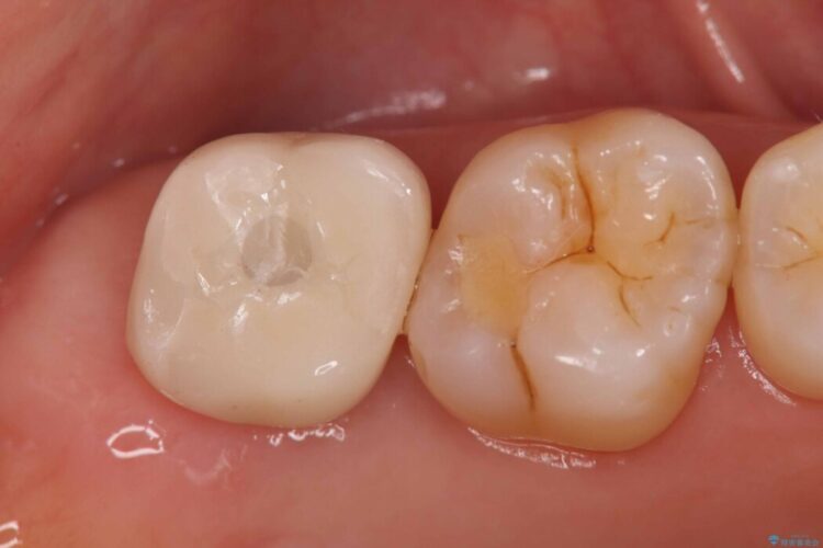 切らない・腫れにくい短期間治療【1DAYインプラント】 治療後画像