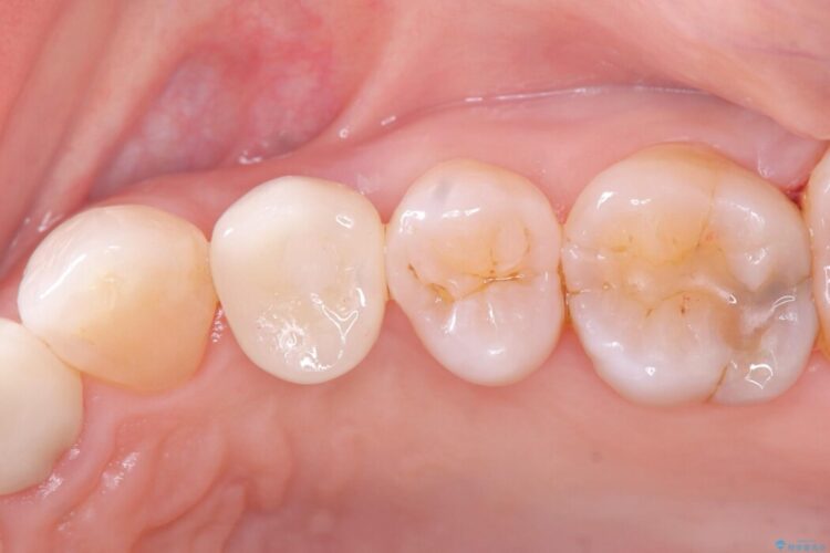 歯根破折した歯のインプラント治療 アフター
