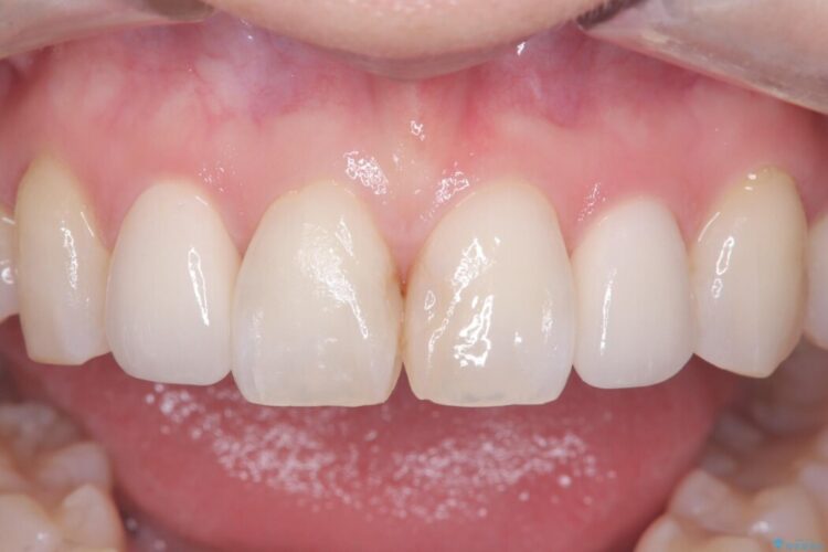 矮小歯と変色した詰め物をオールセラミッククラウンで修復 アフター