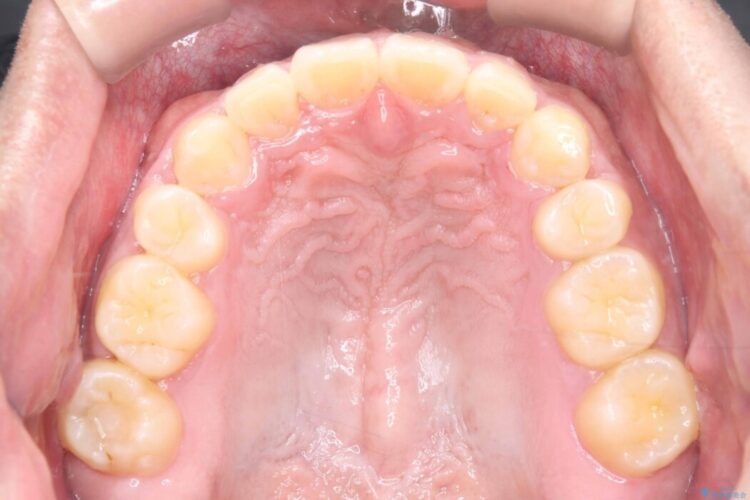 歯のガタつきと口元の突出感の改善 治療後画像