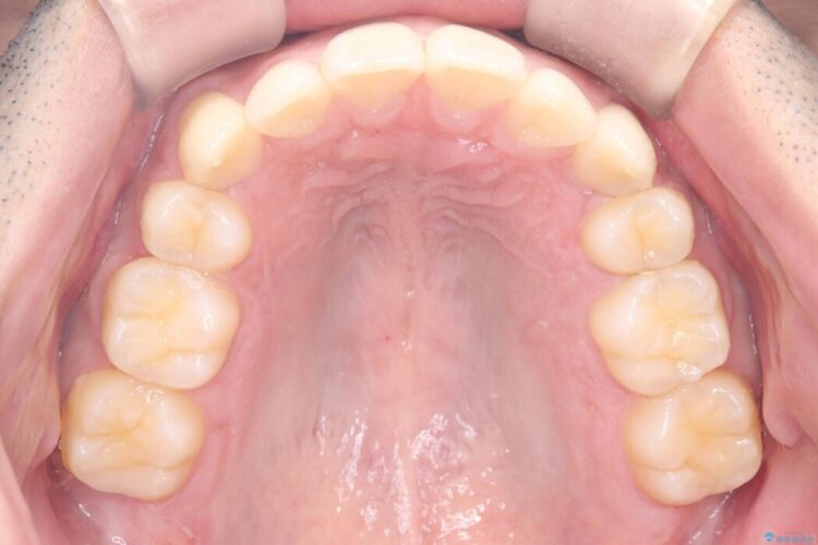 ワイヤー抜歯矯正治療で 治療後画像