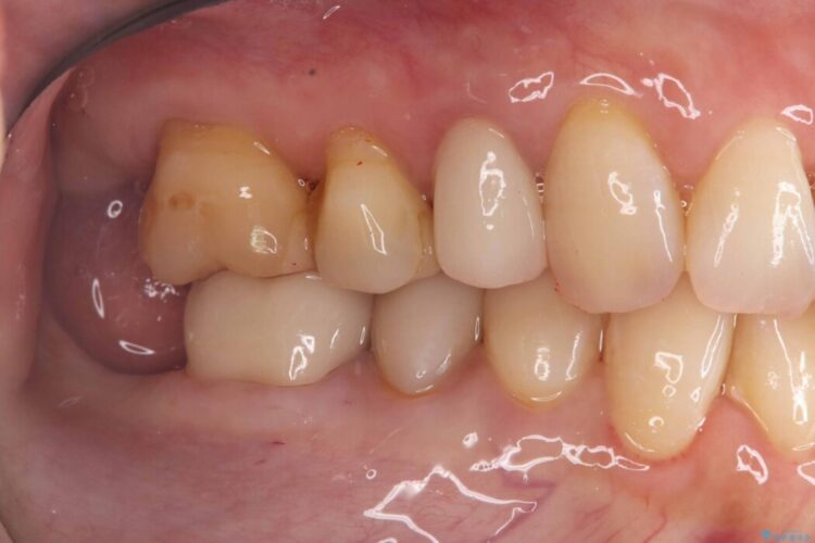 破折したセラミックインレーのやり替え 治療後画像