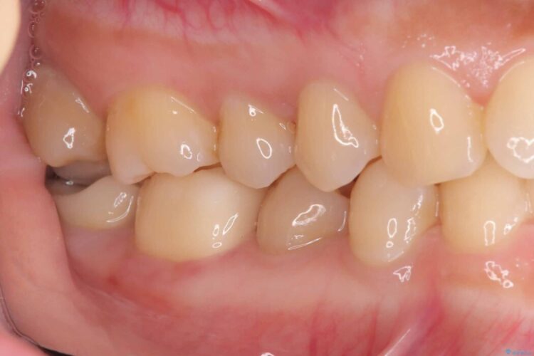 長期的な安定性を重視したセラミック治療 治療後画像