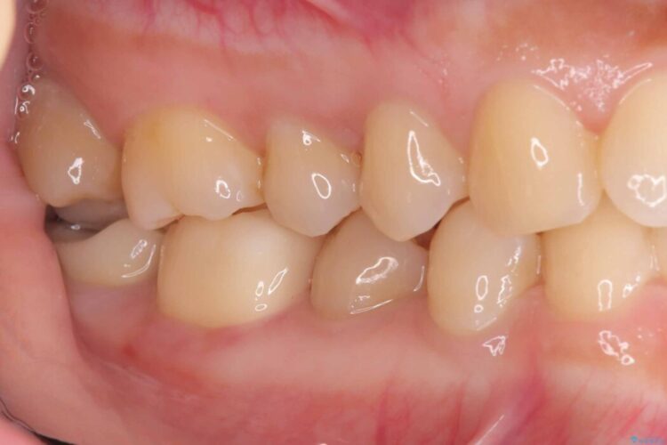 詰め物の下の見えない虫歯 治療後画像