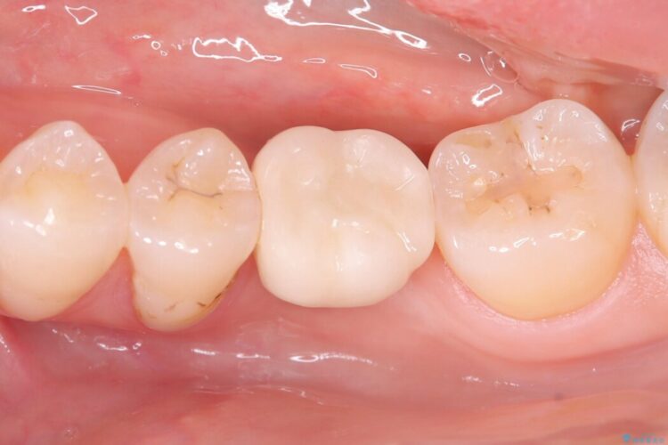 長期間の放置で骨が吸収した部位のインプラント治療 治療後画像