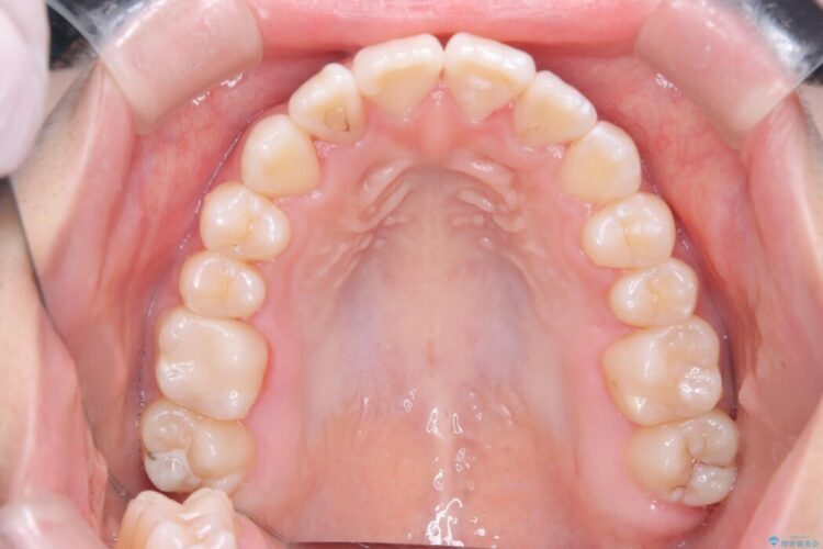 インビザラインで前歯のガタつきを改善 治療後画像