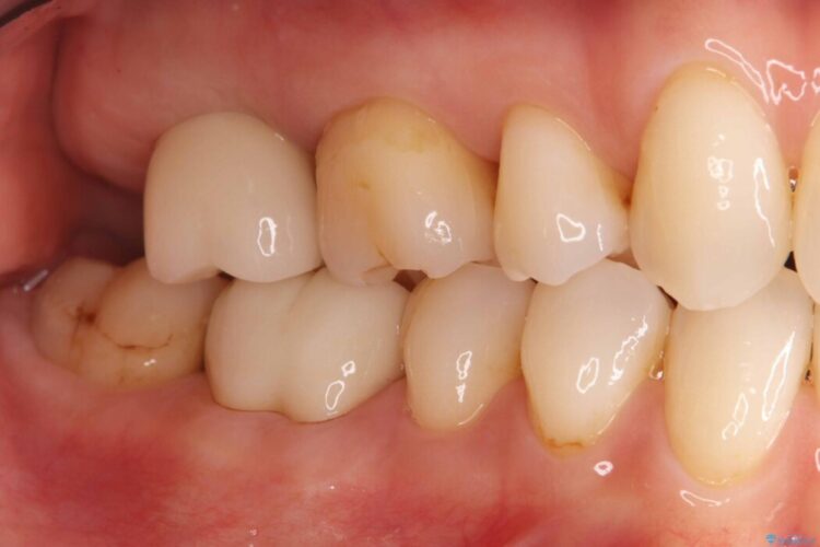 切らない・腫れにくい短期間治療【1DAYインプラント】 治療後画像