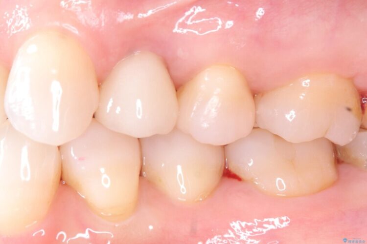 歯根破折した歯のインプラント治療 治療後画像