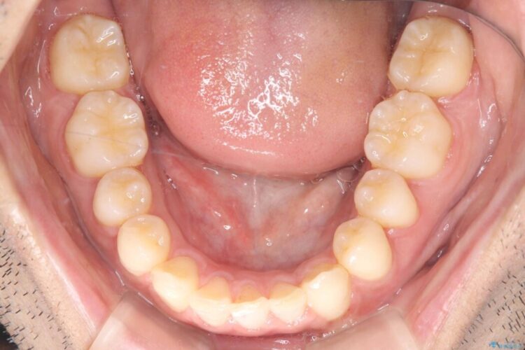 ワイヤー抜歯矯正治療で 治療後画像