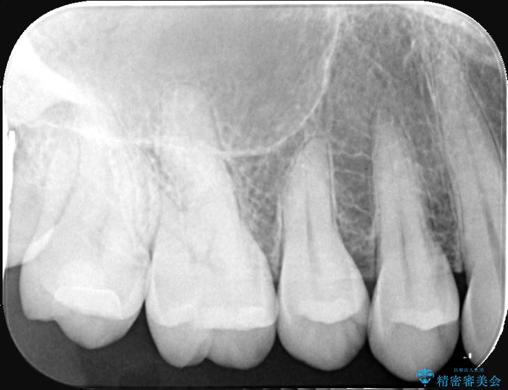 詰め物の下の見えない虫歯 治療後画像