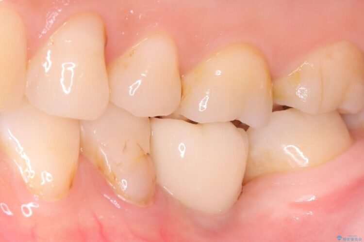 長期間の放置で骨が吸収した部位のインプラント治療 治療後画像
