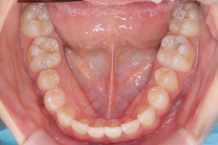 インビザラインで前歯のガタつきを改善 治療後画像