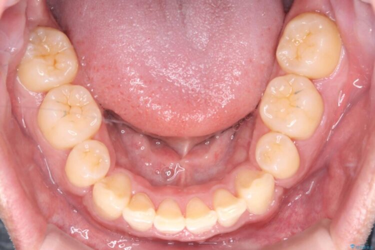 歯のガタつきと口元の突出感の改善 治療後画像