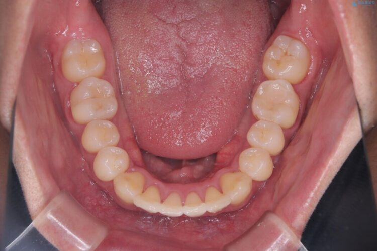 出っ歯を治したい 治療後画像
