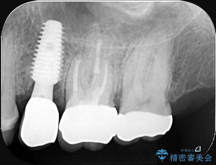 他院で断られた根管内に残った器具を除去 治療後画像